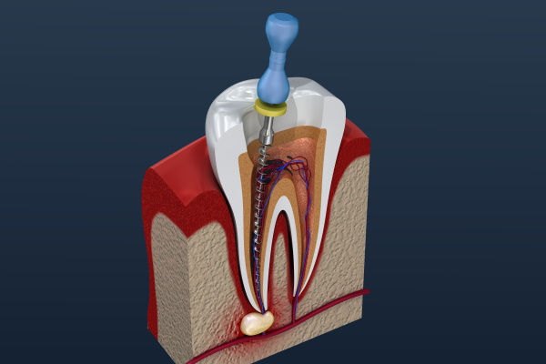 Root canal treatment process. 3D illustration